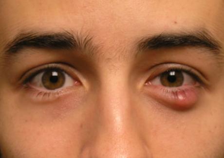 Bệnh đau mắt hột là gì? Triệu chứng và cách điều trị bệnh đau mắt hột.