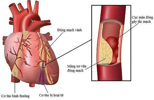 Bệnh nhồi máu cơ tim và những dấu hiệu bệnh nhồi máu cơ tim