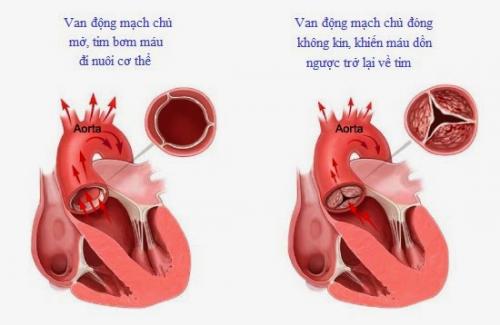 Van tim là gì? Bạn đã biết gì về bệnh van tim?