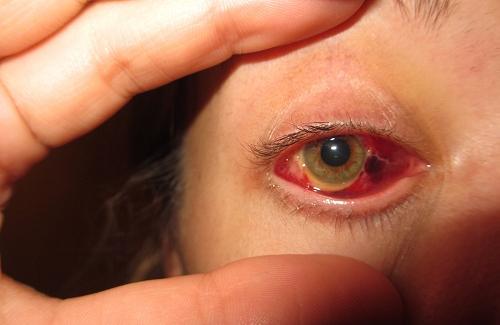 Bệnh viêm loét giác mạc có thể gây mù lòa vĩnh viễn