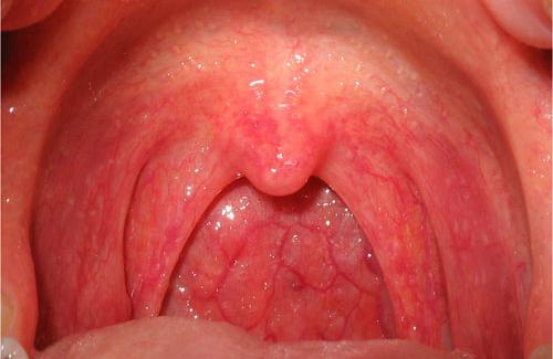 Ung thư vòm họng - cách phòng tránh ung thư vòm họng