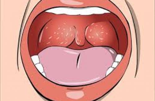 Ung thư vòm họng là gì? Dấu hiệu nhận biết và cách điều trị