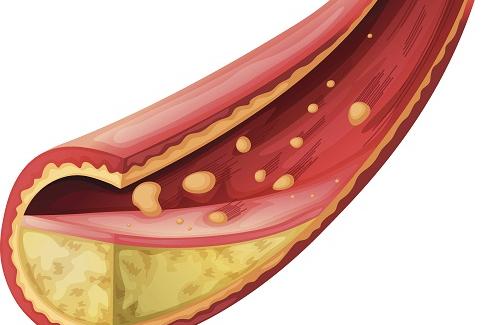 Cholesterol là gì? Thế nào là cholesterol xấu, cholesterol tốt?