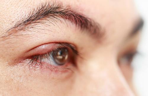 Nguyên nhân, triệu chứng và cách điều trị bệnh nấm mắt