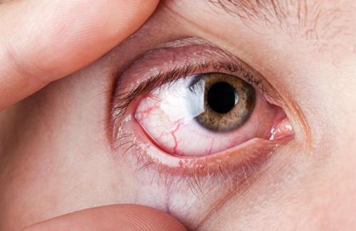 Nguyên nhân, triệu chứng và cách điều trị bệnh đau mắt đỏ