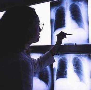 Hãy tìm hiểu những triệu chứng áp-xe phổi trước khi quá muộn