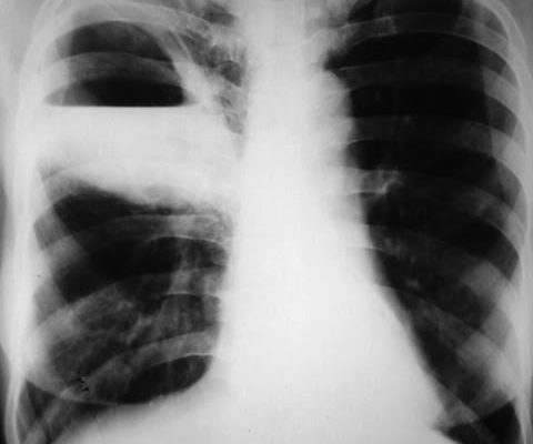 Lưu ý ngay sáu biến chứng áp-xe phổi thường gặp sau đây