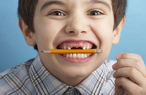 Điều trị sâu răng ở trẻ em có thực sự cần thiết không?