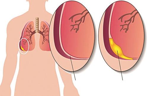 Hội chứng tràn dịch màng phổi và những dấu hiệu dễ nhận biết