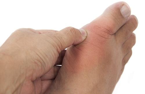 Những loại thuốc chữa bệnh gout (gút) hiệu quả thường dùng