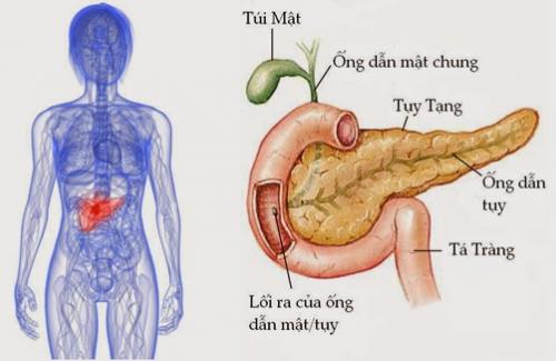 Bệnh viêm tụy - những nguyên nhân gây bệnh viêm tụy