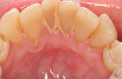 Vôi răng là gì? Cách loại bỏ vôi răng hiệu quả