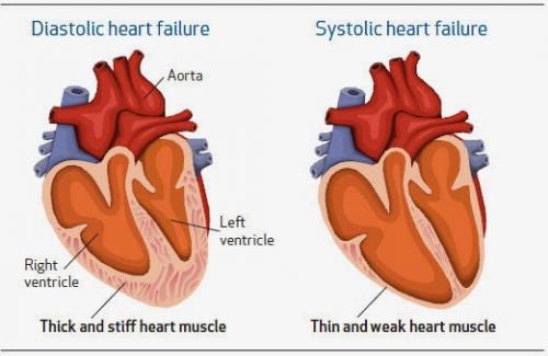 Suy tim tâm trương - một dạng bệnh nguy hiểm khác của bệnh suy tim