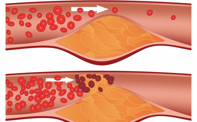 Tắc nghẽn mạch máu là gì? Cách phòng ngừa bệnh bạn cần nắm rõ