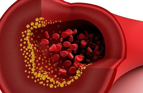 Những nguyên nhân rối loạn lipid máu bạn đã biết hết chưa?