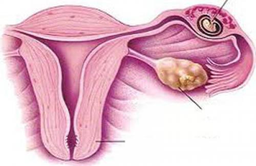 Thai ngoài tử cung là gì? Dấu hiệu nhận biết mẹ bầu cần nắm rõ