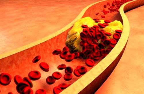 Bạn đã biết hết những triệu chứng rối loạn lipid máu chưa?
