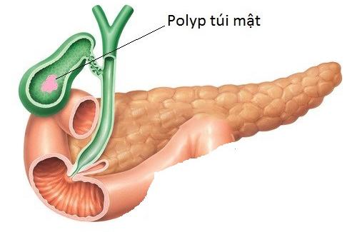 Bệnh polyp túi mật - triệu chứng và cách điều trị bệnh
