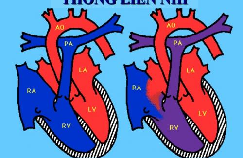 Bệnh thông liên nhĩ - một bệnh tim bẩm sinh hiếm gặp
