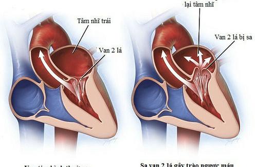 Bốn biến chứng thấp tim gây ảnh hưởng chất lượng cuộc sống