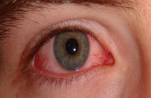 Lây lan bệnh đau mắt đỏ qua những đường nào?