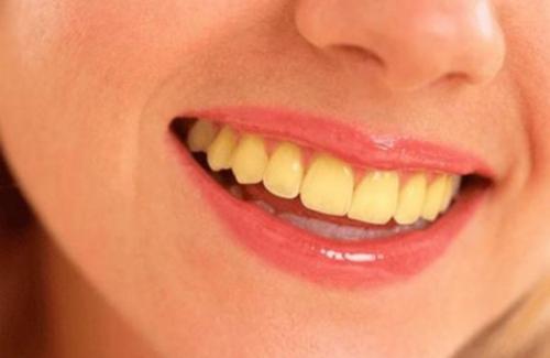 Tránh xa bảy thực phẩm gây vàng răng để khỏi tốn tiền đi làm răng