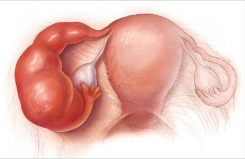 Tìm hiểu một số những thông tin về bệnh viêm buồng trứng