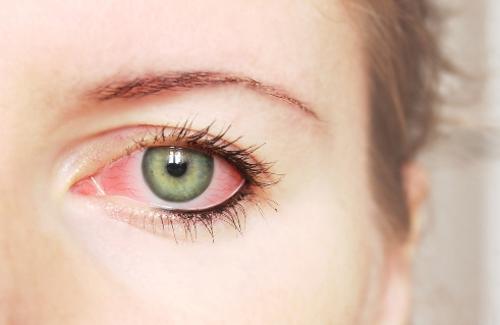 Bệnh đau mắt ở trẻ thường gặp mà các phụ huynh nên lưu ý
