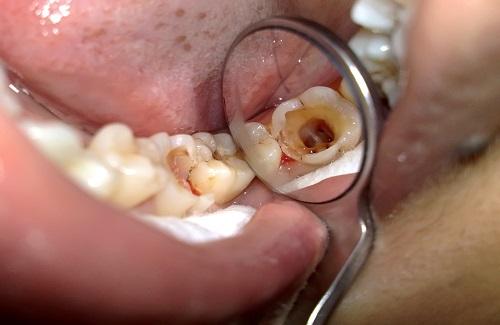 Bệnh tủy răng và những điều bạn nhất định phải biết