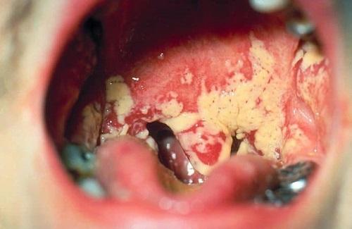 Nấm miệng và những thông tin cần biết về bệnh nấm miệng