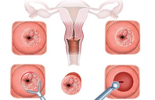 Những biểu hiện viêm cổ tử cung mà chị em nên biết