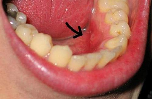 Tìm hiểu về bệnh u răng – căn bệnh về răng cực kỳ nguy hiểm