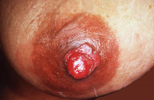 Bệnh paget vú là gì? Nguyên nhân, triệu chứng của bệnh