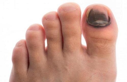 Đen móng chân không đơn giản chỉ là tụ máu mà còn cảnh báo nhiều căn bệnh khác