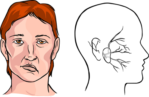 Tìm hiểu về liệt nửa mặt - nguyên nhân và cách điều trị bệnh liệt nửa mặt