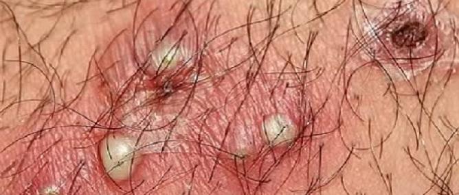 Viêm nang lông là gì? Nguyên nhân gây viêm nang lông?