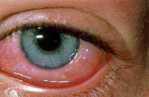 Dị ứng mắt – Bệnh lý dị ứng tuyệt đối không được xem thường