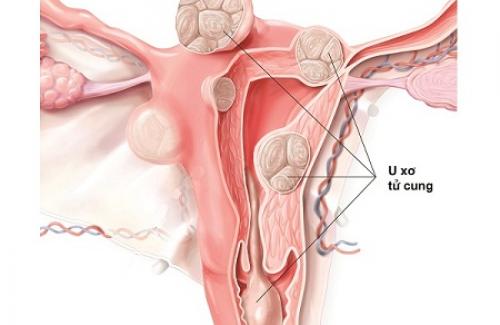 U xơ cổ tử cung là gì? Dấu hiệu nhận biết phụ nữ mắc u xơ cổ tử cung