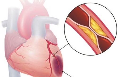 Thế nào là bệnh mạch vành? Cách chữa trị và phòng bệnh mạch vành