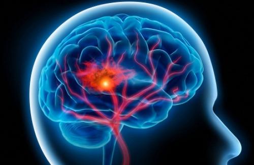 Xuất huyết não là gì? Triệu chứng của người bị xuất huyết não