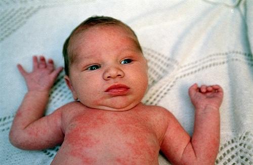 Các mẹ nên lưu ý về bệnh chàm Eczema ở trẻ sơ sinh và trẻ nhỏ