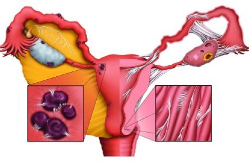 Lạc nội mạc tử cung là gì? Biểu hiện và cách điều trị bệnh
