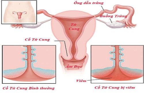 Tìm hiểu về cách chữa viêm cổ tử cung tùy từng giai đoạn bệnh cụ thể