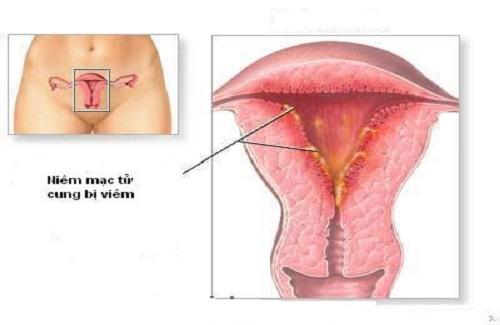 Viêm tử cung - Triệu chứng và cách phòng tránh khi mắc bệnh