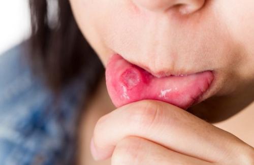 Viêm niêm mạc miệng là bệnh gì? Triệu chứng, nguyên nhân và điều trị bệnh