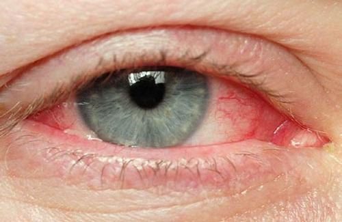 Phương pháp chữa đau mắt đỏ bằng thuốc nam hiệu quả bạn đã biết chưa