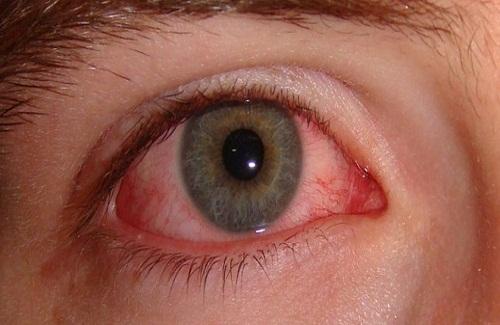 Mách bạn một số phương pháp chữa đau mắt đỏ tại nhà hiệu quả