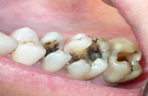 Có nên nhổ răng khôn bị sâu nặng không hay là còn cách nào khác để điều trị?
