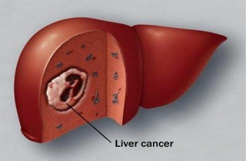 Các phương pháp phẫu thuật ung thư gan mà có thể bạn chưa biết