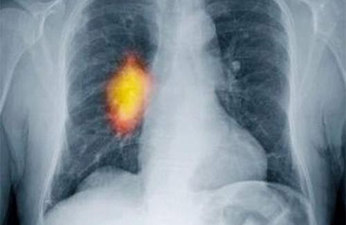 Phù phổi cấp là bệnh gì - Triệu chứng, nguyên nhân và điều trị bệnh